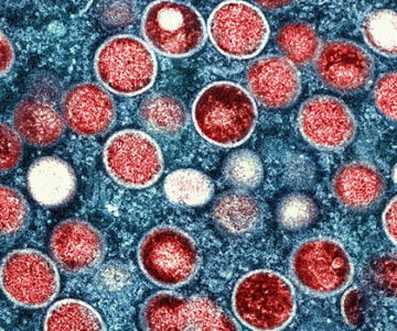 Dallas County declares health emergency on monkeypox outbreak 10